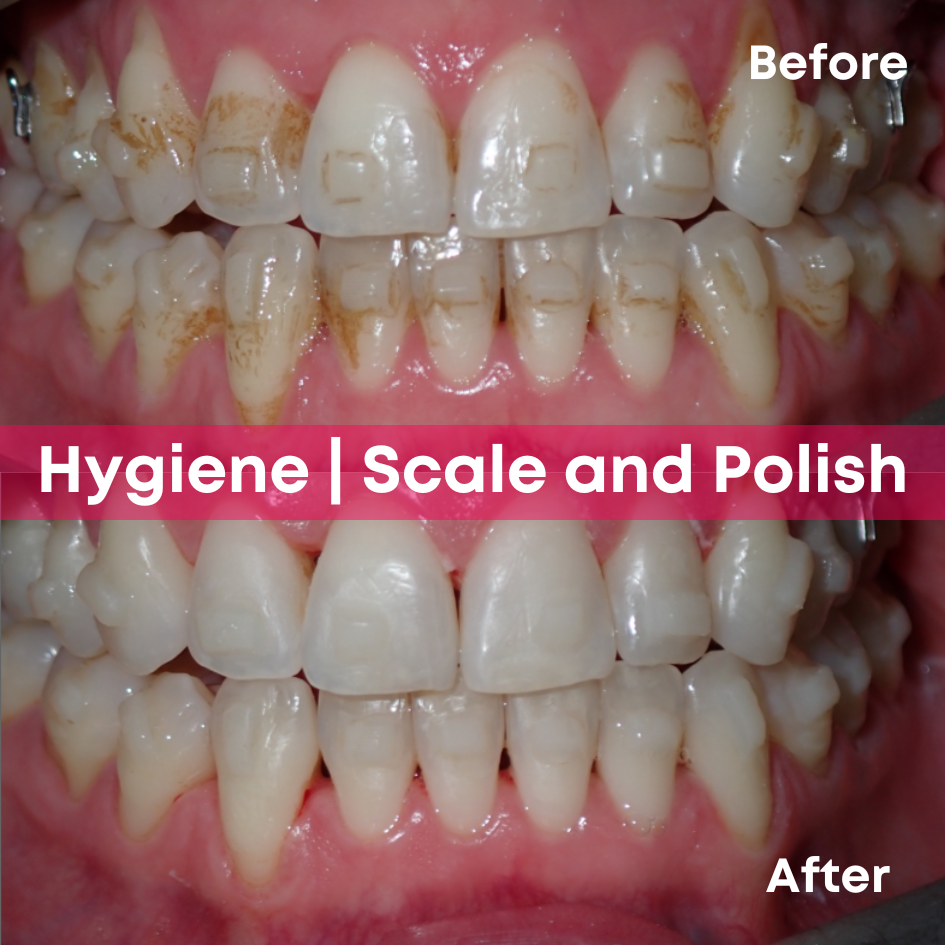 Hygiene -Scale and Polish